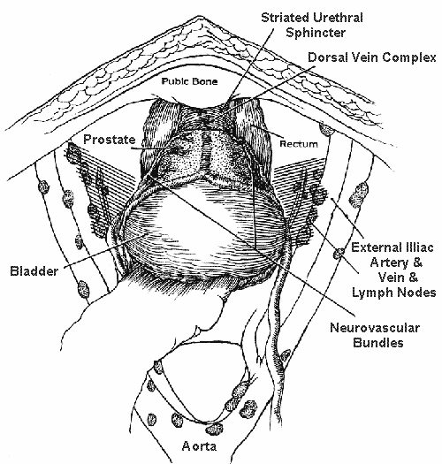 Figure 2 of the nerve-sparing radical retropubic prostatectomy RRP technicque of Dr. Patrick Walsh