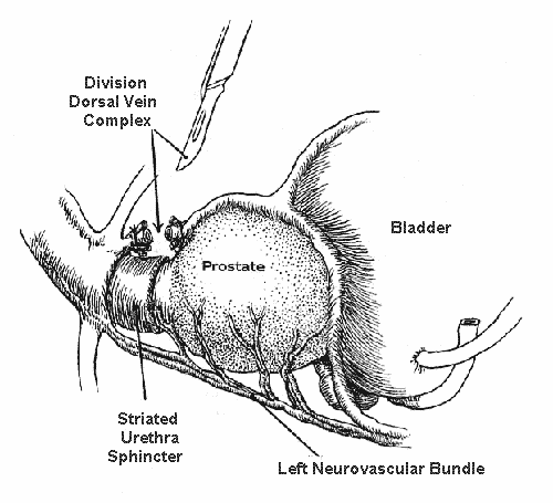 Figure 3 of the nerve-sparing radical retropubic prostatectomy RRP technicque of Dr. Patrick Walsh