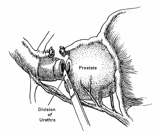 Figure 4 of the nerve-sparing radical retropubic prostatectomy RRP technicque of Dr. Patrick Walsh