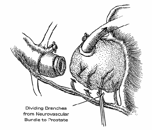 Figure 5 of the nerve-sparing radical retropubic prostatectomy RRP technicque of Dr. Patrick Walsh