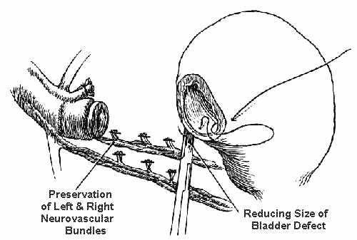 Figure 7 of the nerve-sparing radical retropubic prostatectomy RRP technicque of Dr. Patrick Walsh
