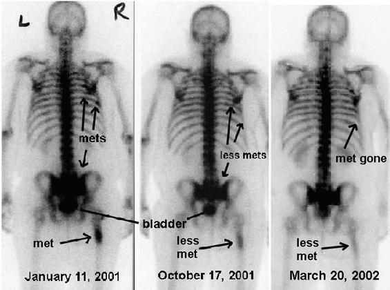 enlarged side by side comparison of 3 bone scans
