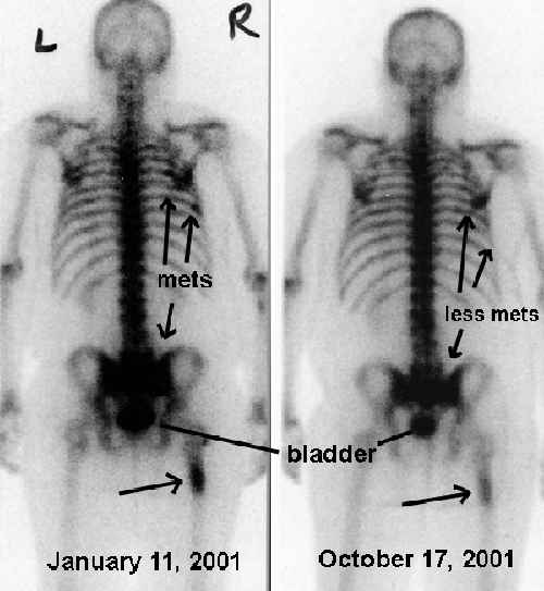 comparison of bone scans from January and October 2001