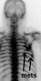 portion of my bone scan of January 11, 2001 - click here for full image compared to October 17, 2001