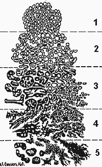 Gleason's drawing of the five grades