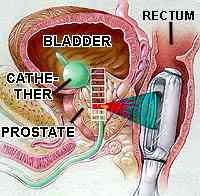 drawing showing an HIFU unit in place, directed towards a portion of the prostate gland