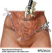 drawing of laparascopic surgery