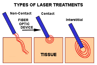 drawing showing types of laser treatments
