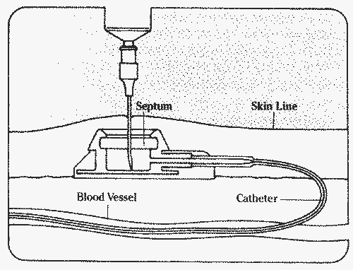 side view of port in place