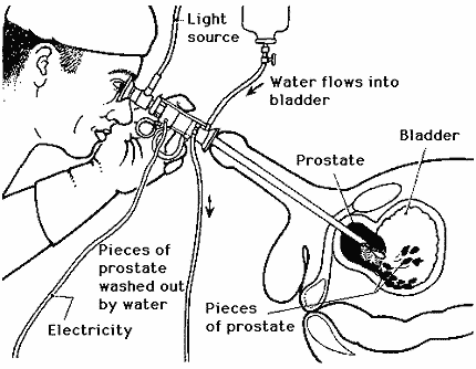 line drawing of a transurethral prostatectomy