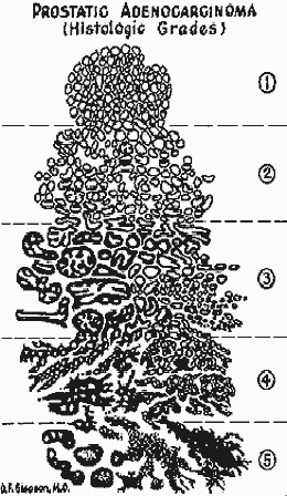 drawing by Gleason showing the 5 types of cells for grading