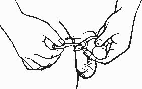 illustration of the procedure