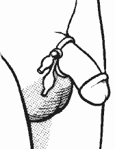 illustration of the procedure