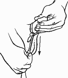 illustration of the procedure