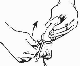 illustration of the procedure