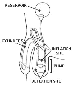 drawing showing the placement of the implant
