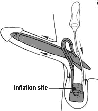 line drawing showing the erection and direciton of flow