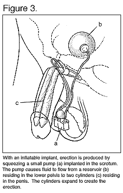 line drawing of a penile implant