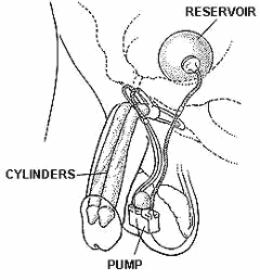 another line drawing showing placement