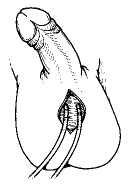 line drawing of the procedure